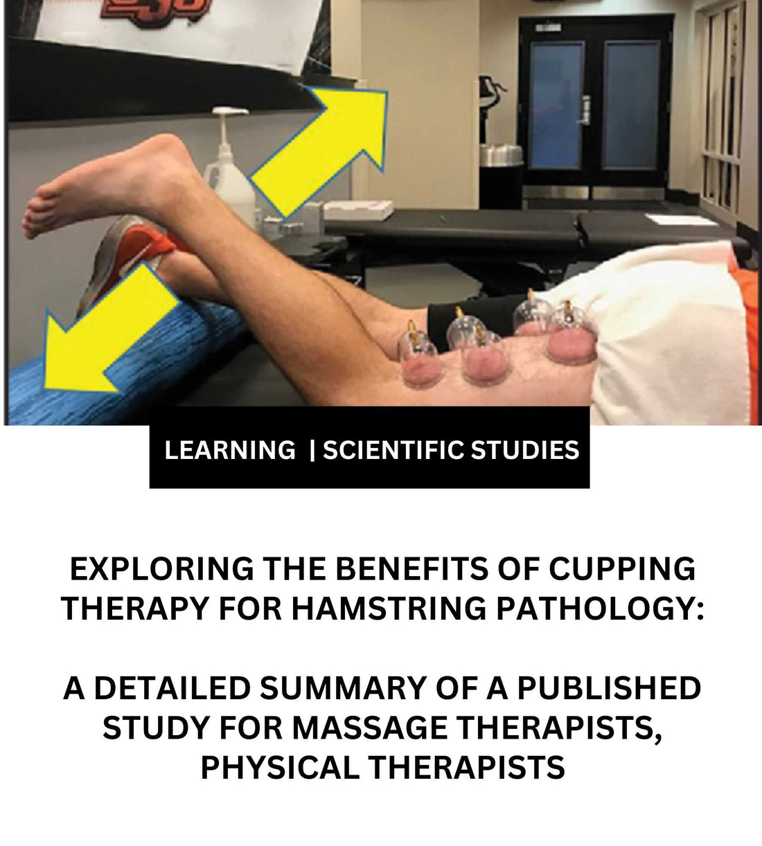 Study Summary: Exploring the Benefits of Cupping Therapy for Hamstring Pathology