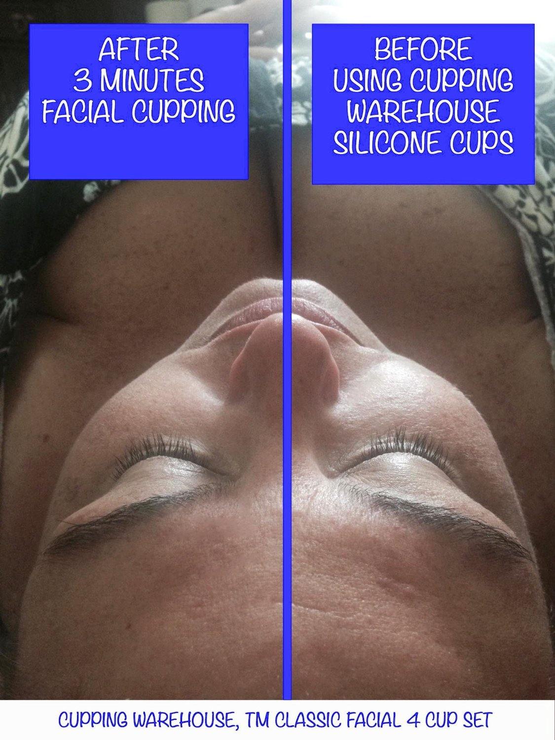 cupping, cupping therapy, face cup, therapy cups, sculpting, cupping in therapy, body shaping, cupped, cellulite, face toning, love cups, cupping benefits, massage cups, cupping massage, suction cups for therapy, cupping set