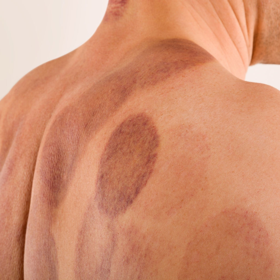 Cupping Marks: What They Are and How Long They Last