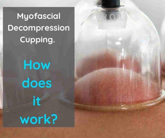 Modern Cupping therapy, AKA Myofascial Decompression Cupping: How does it work and what are the benefits? - Cupping Warehouse