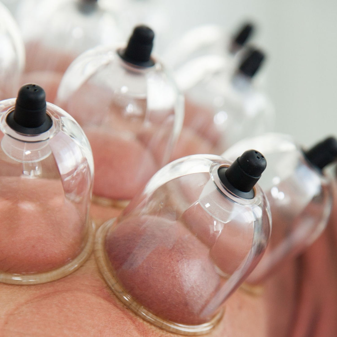 Sports cupping: Why do Athletes Use Cupping Therapy?